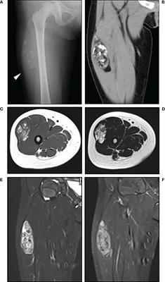 Case report: Atypical lipomatous tumor of the thigh in a four-year-old girl